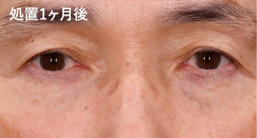 1ヶ月後