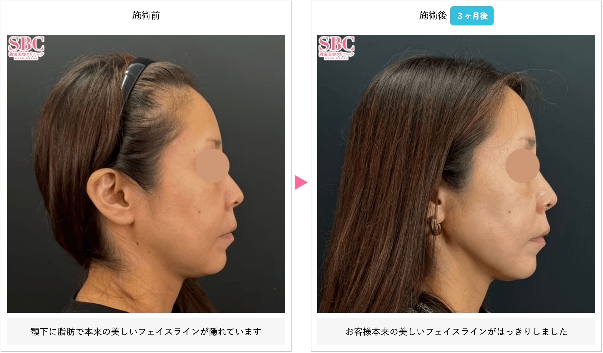 自然なフェイスラインに