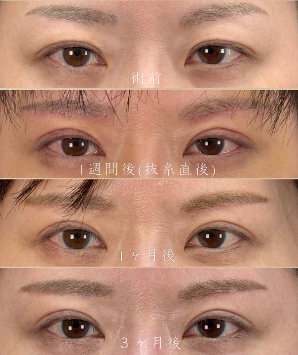縫合を伴う切開系の治療