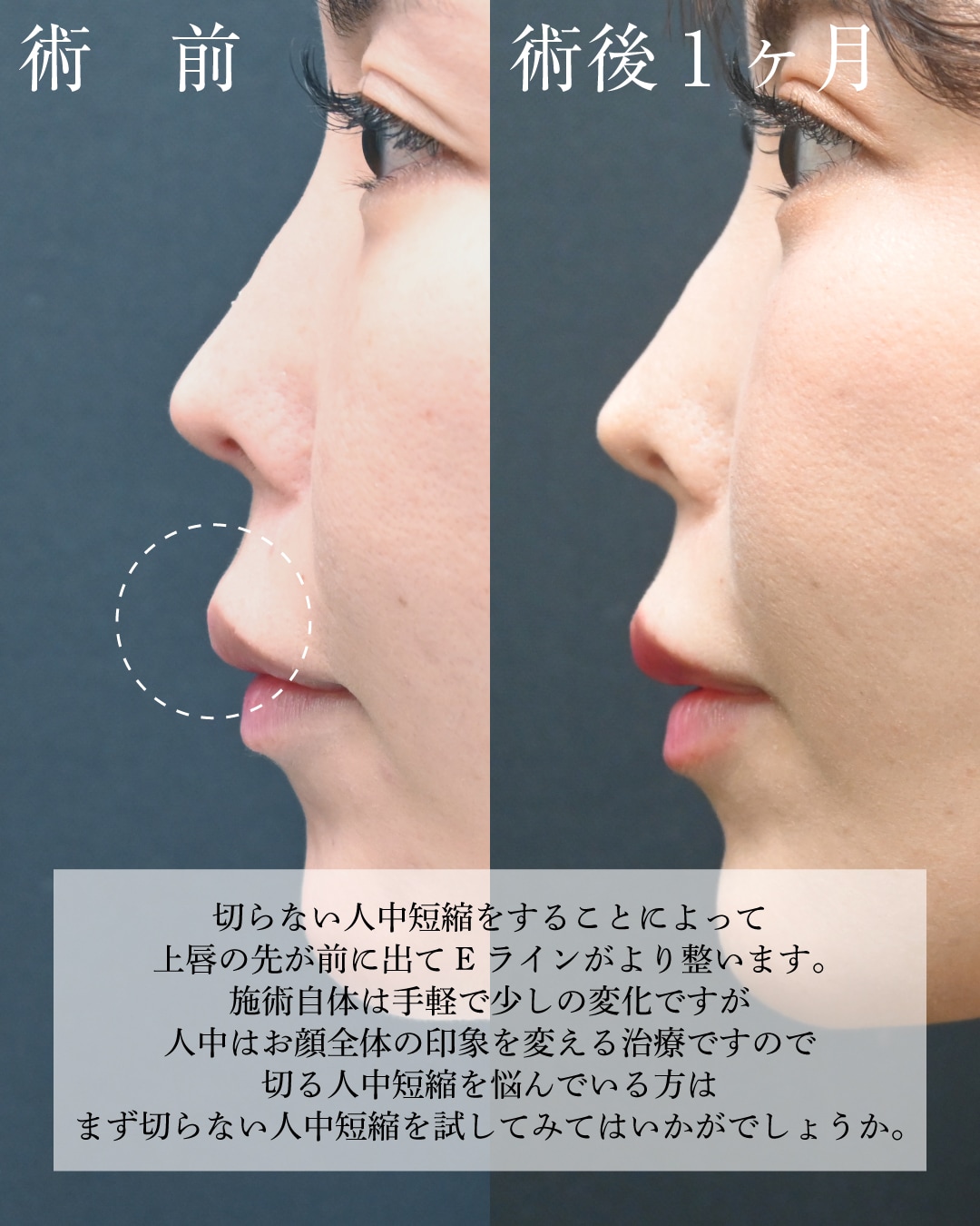 切らない人中短縮症例