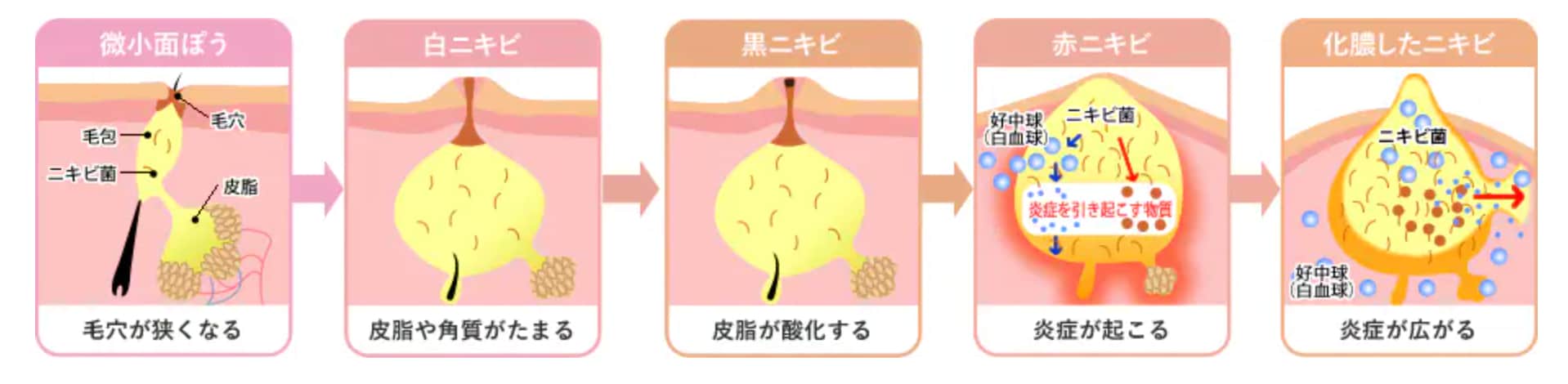 ニキビ発生メカニズム