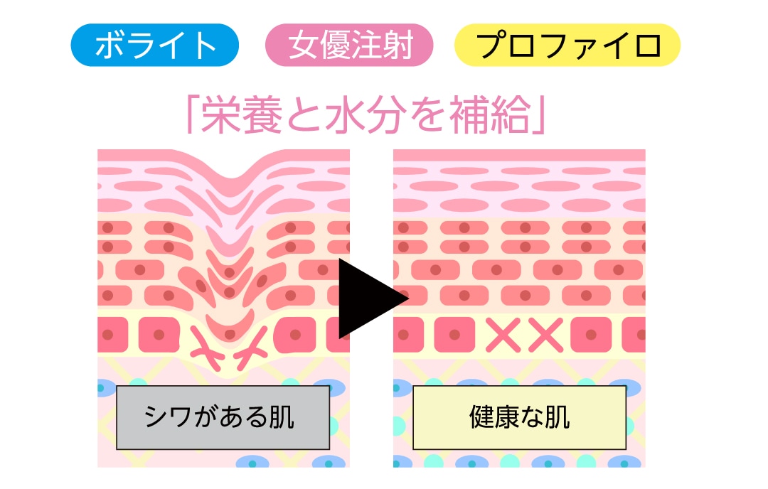 肌育注射の種類は？