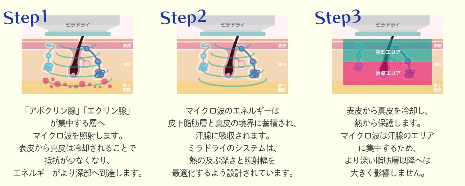 メスを使わず汗腺を壊す「ミラドライ」の仕組み