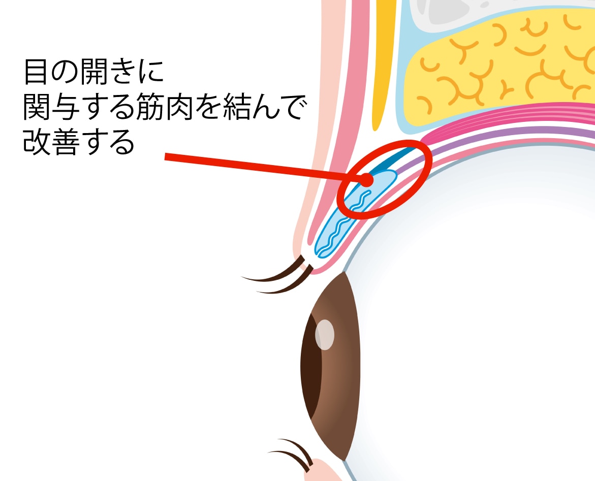切らない眼瞼下垂（真崎式）