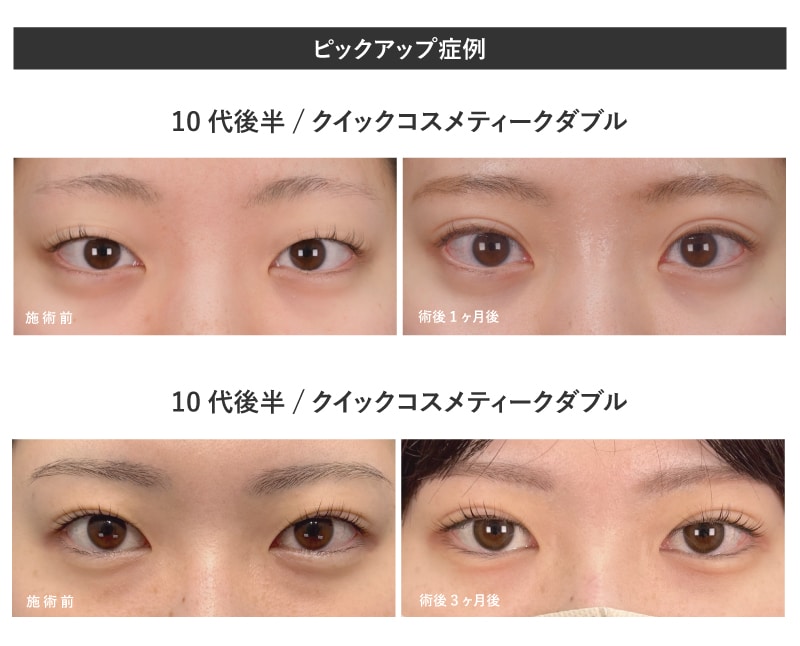 10代20代の学生が長期休みに二重をする理由とは？