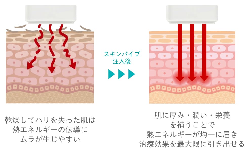 さらに効果を高める！レーザー治療との相性抜群