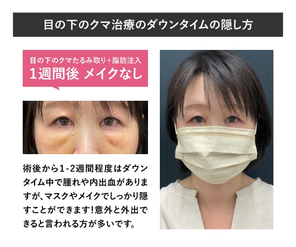 マスクやメイクでの隠し方<br />
