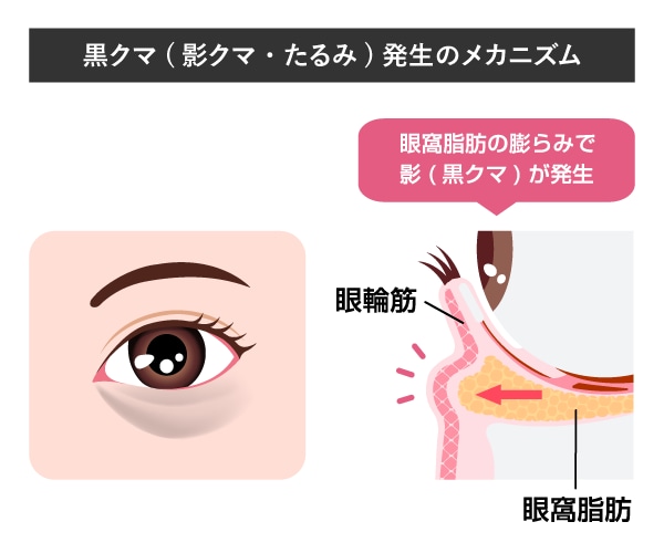 黒クマ（影クマ）の正体は眼窩脂肪の突出