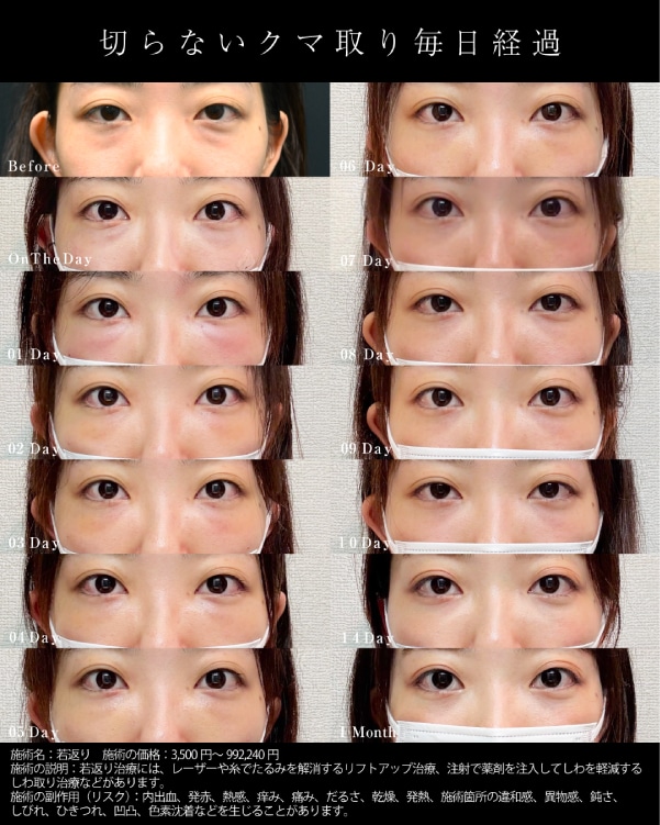 ダウンタイム経過