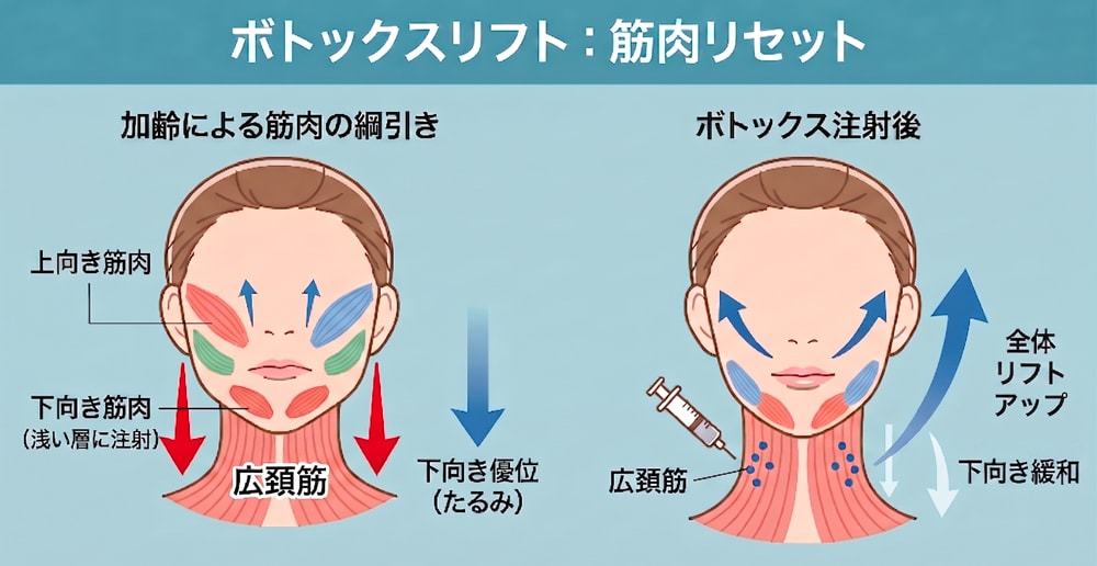 下向きの引っ張りをリセットする「ボトックスリフト」の仕組み