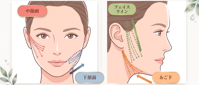 糸リフトを入れる部位