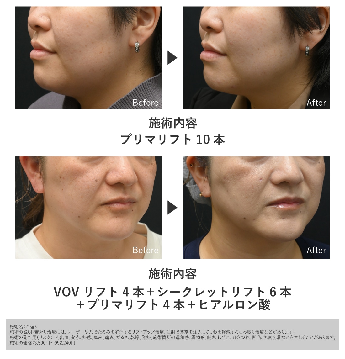 あご下・二重あごの改善症例