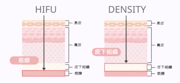 リフトアップ治療の新定番【ハイフ×デンシティ】併用しないともったいない！