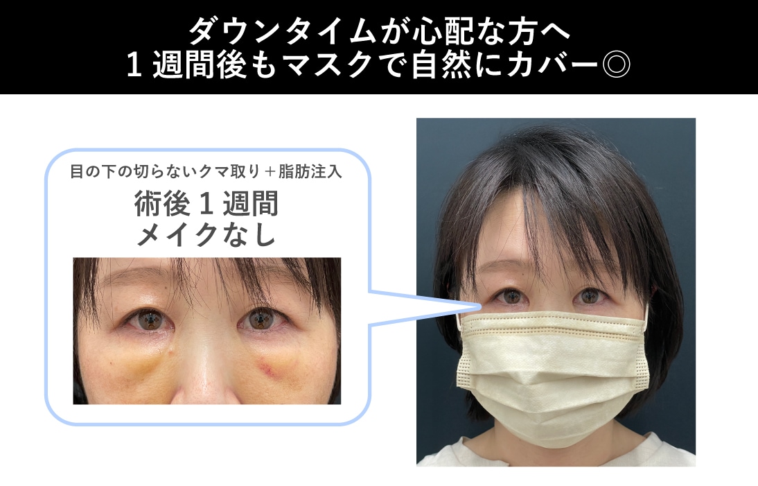 ダウンタイムは隠せます！