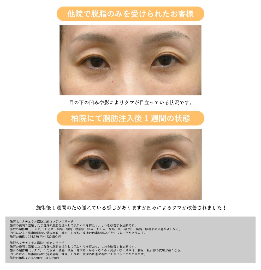 脂肪注入は必要？