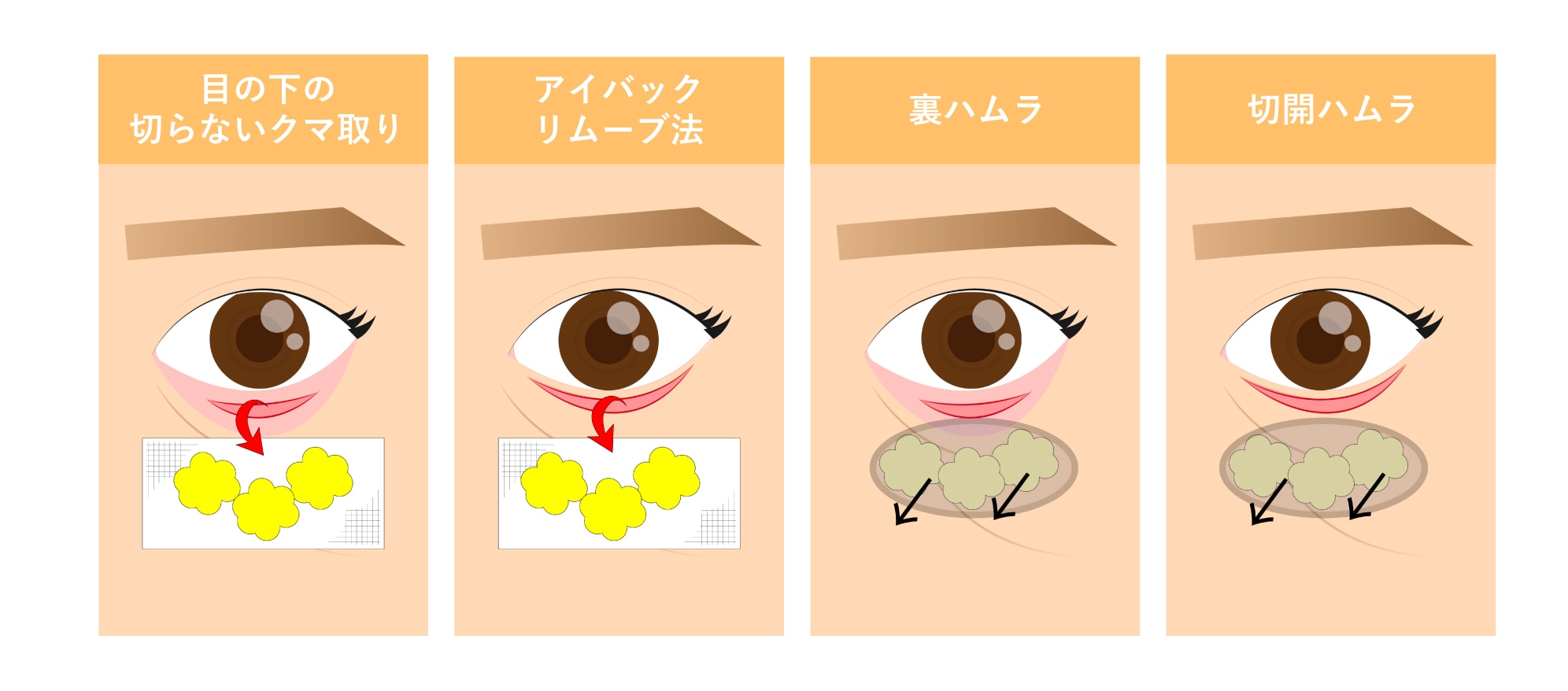 クマ取り治療の種類
