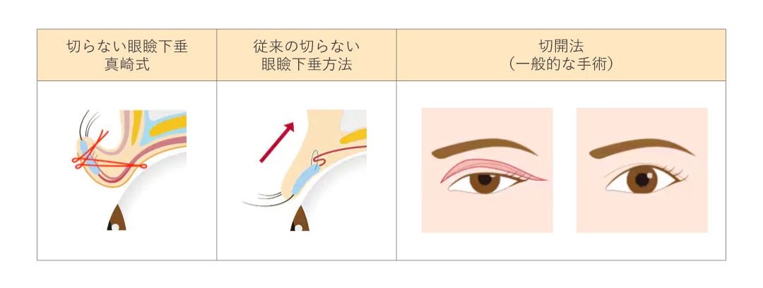 【比較表】真崎式・従来の非切開法・切開法の違い