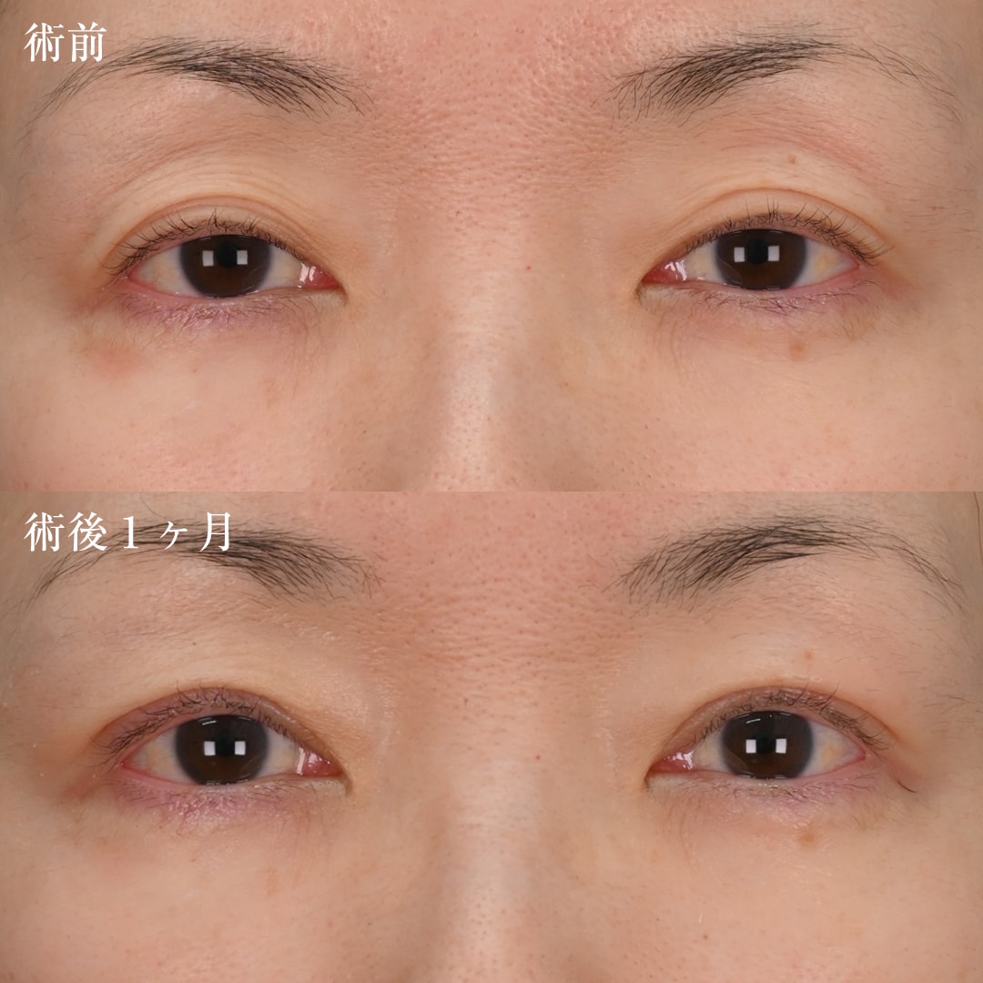 上田医師執刀！真崎式の症例