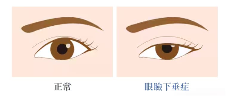 そもそも「眼瞼下垂（がんけんかすい）」とは？