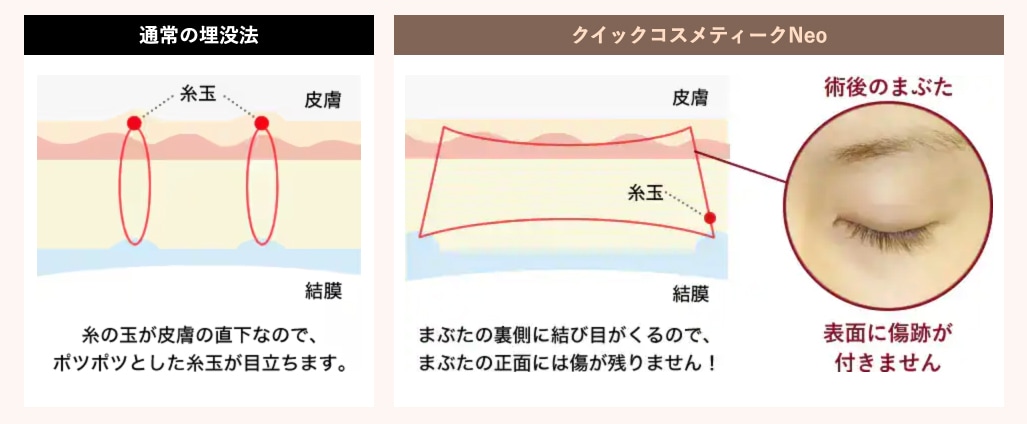 まぶたの表面に傷がつかない画期的な埋没法