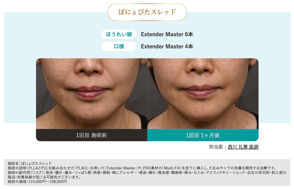 ほうれい線・マリオネットラインに特化した最新ショートスレッド