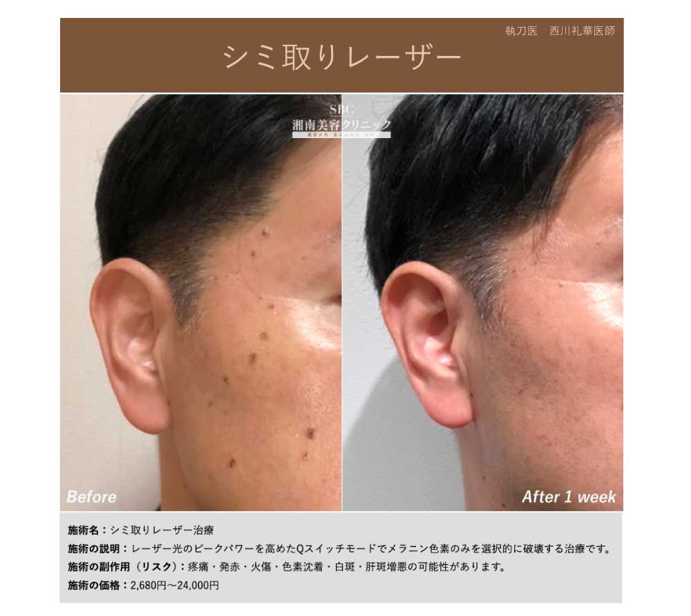 シミ取りレーザー