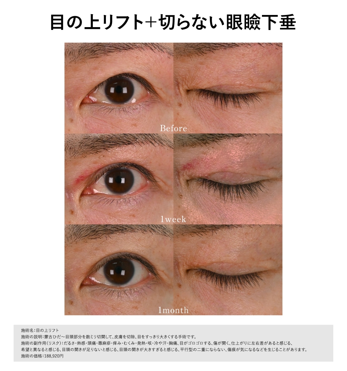 目の上リフト