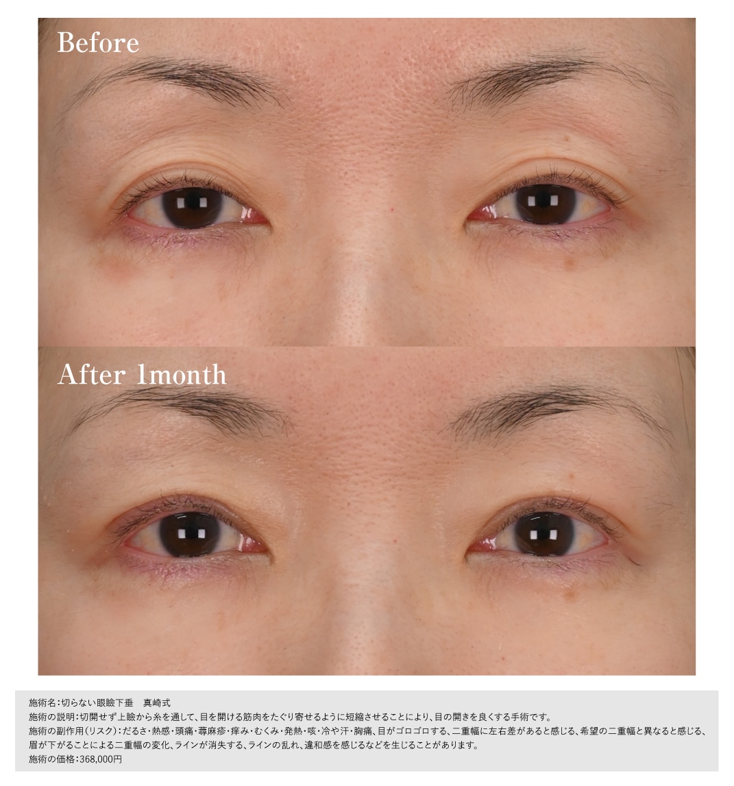 切らない眼瞼下垂 真崎式