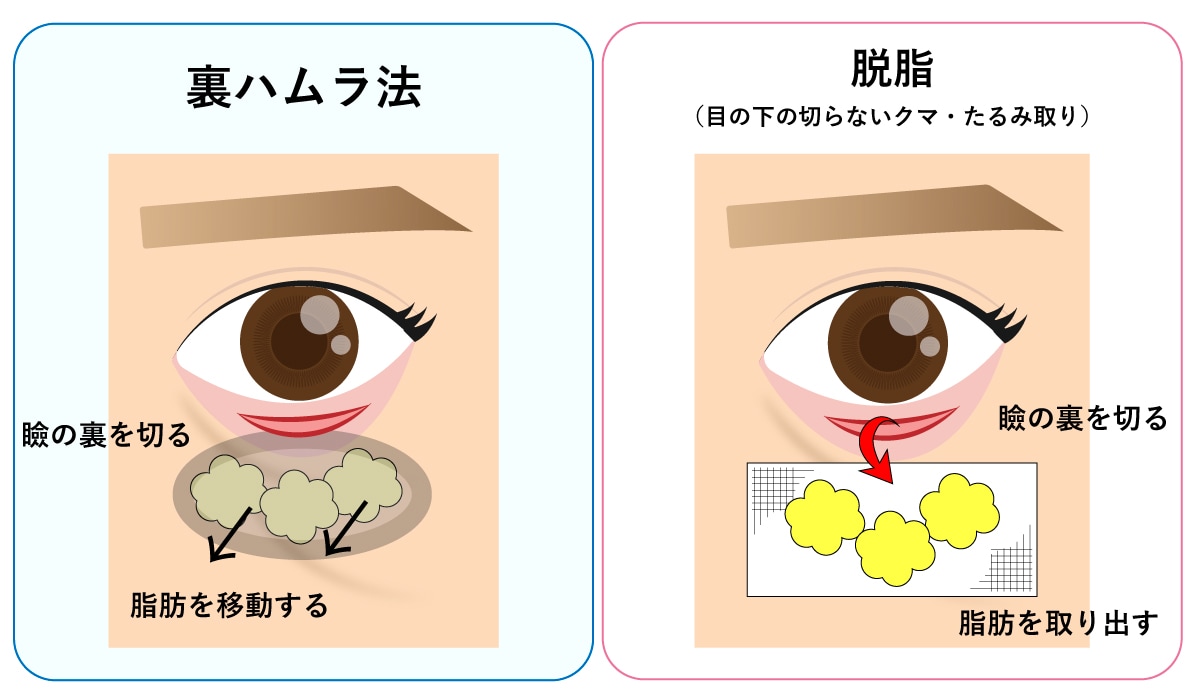 「裏ハムラ法」と「脱脂」の違い