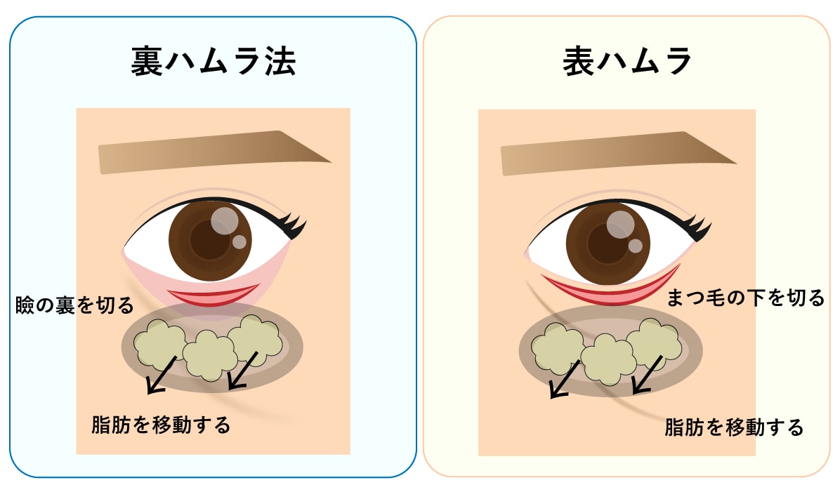 「裏ハムラ法」と「表ハムラ法」の違い