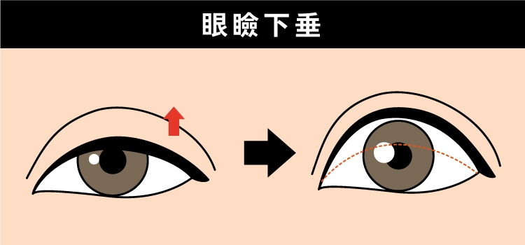 目の開きを改善して黒目を大きくみせる【眼瞼下垂】