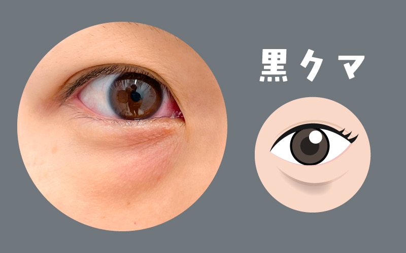 ❸黒クマ(影クマ)：たるみの段差が影を生むタイプ