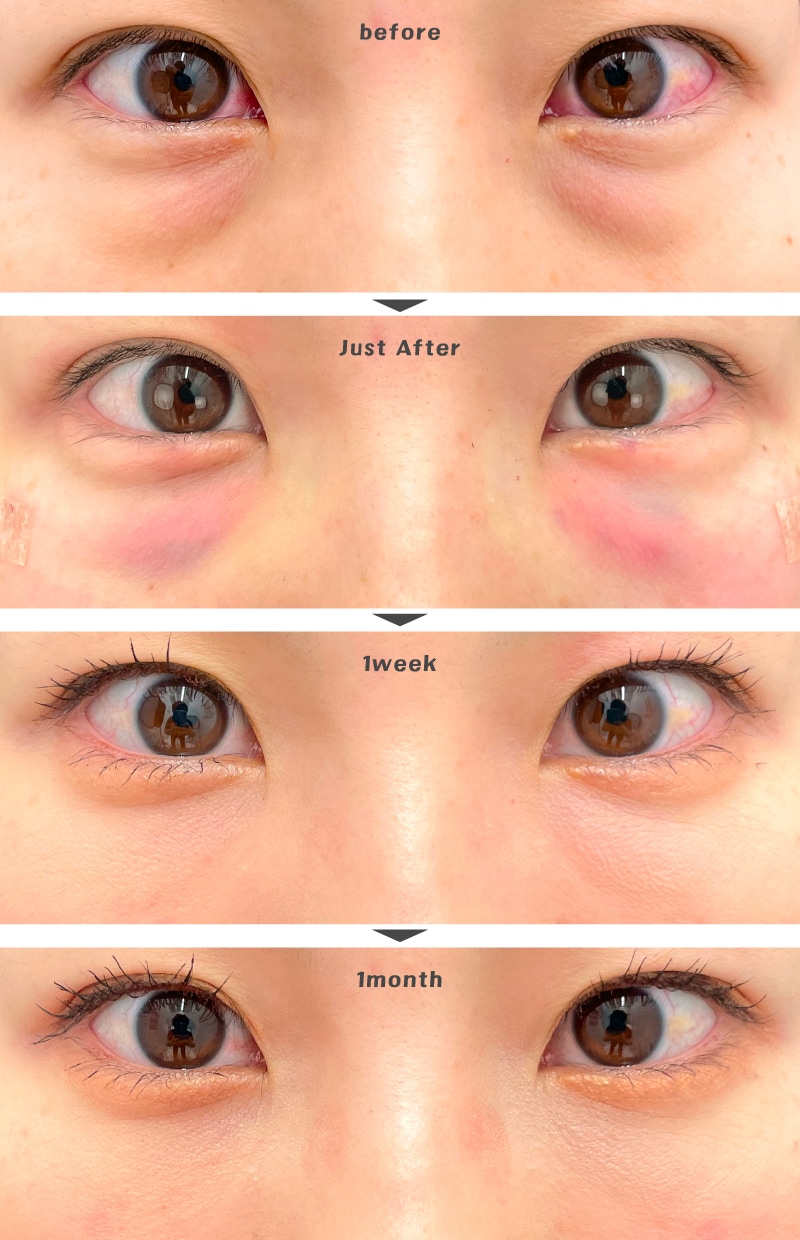 目の下の切らないたるみ取り