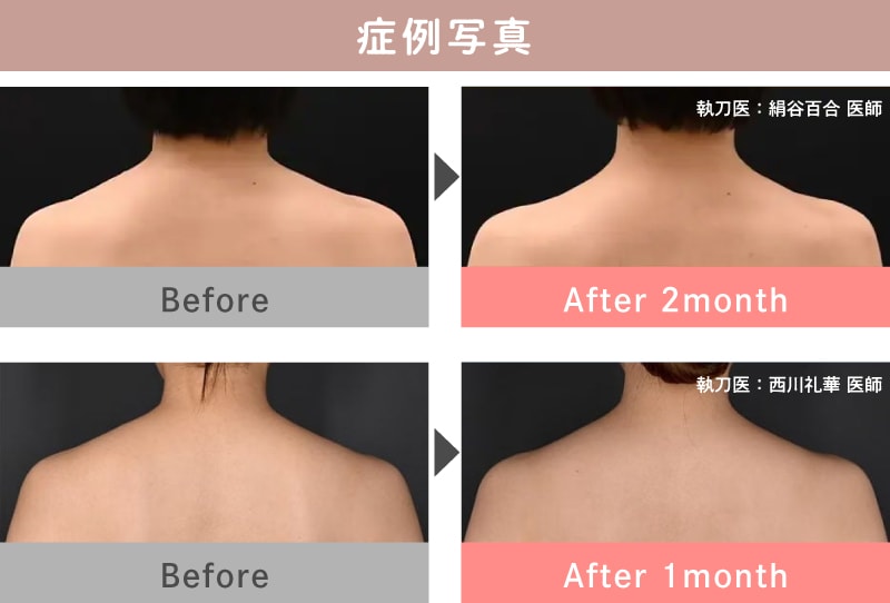 3. 肩ボトックス