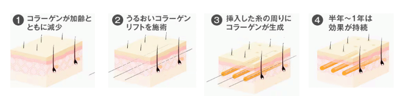 うるおいコラーゲンリフトの効果とは？！