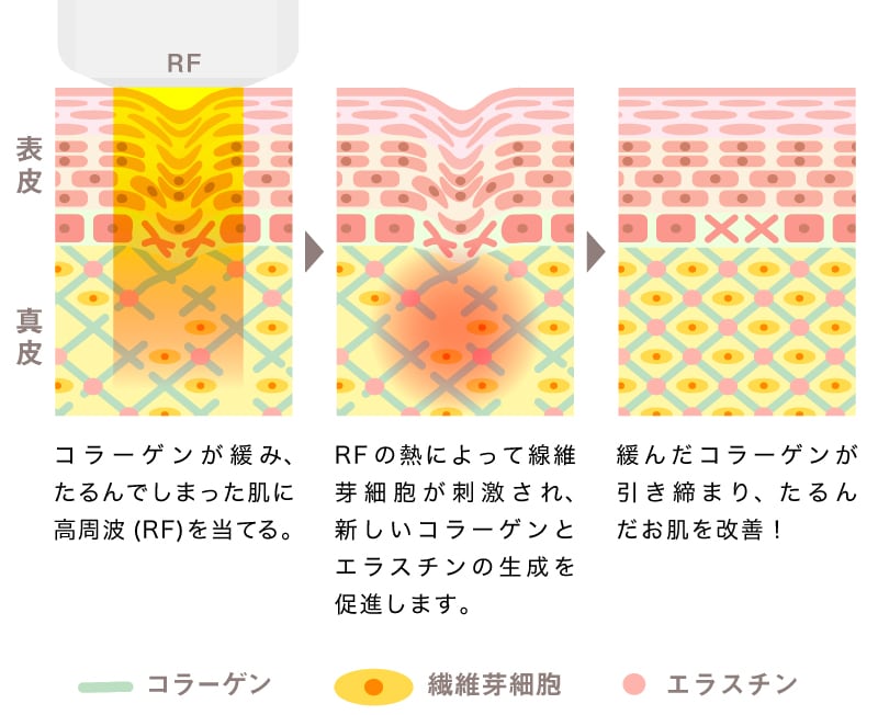 そもそも「高周波」だと何がいいの?