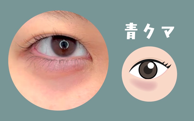 ❶青クマ：血行不良が透けて見えるタイプ