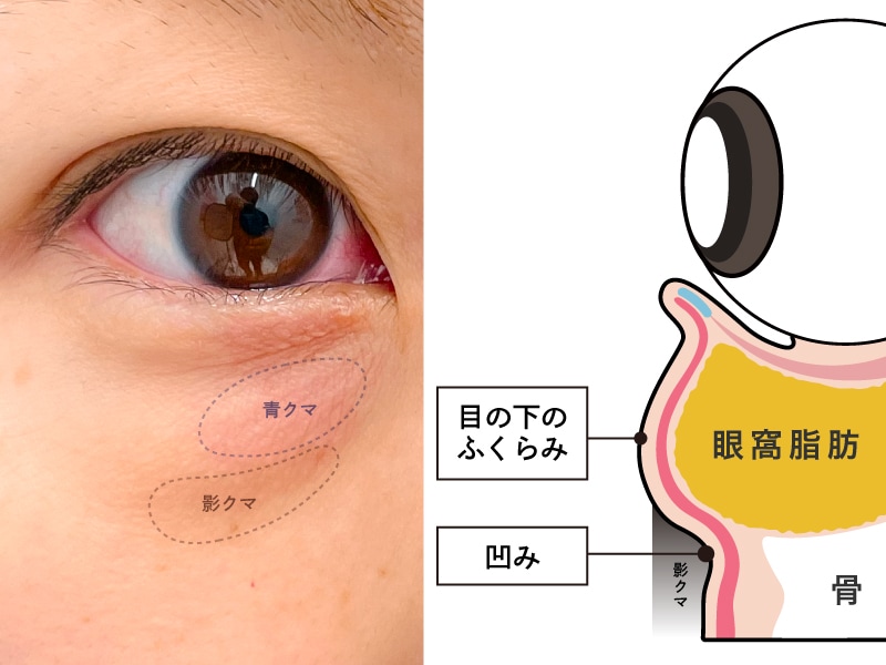 その目の下のクマ、実はほとんどが「黒クマ」です