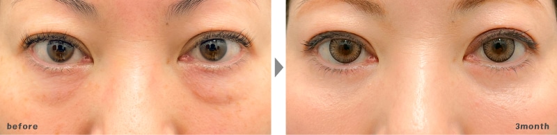 40代 | 切開ハムラ