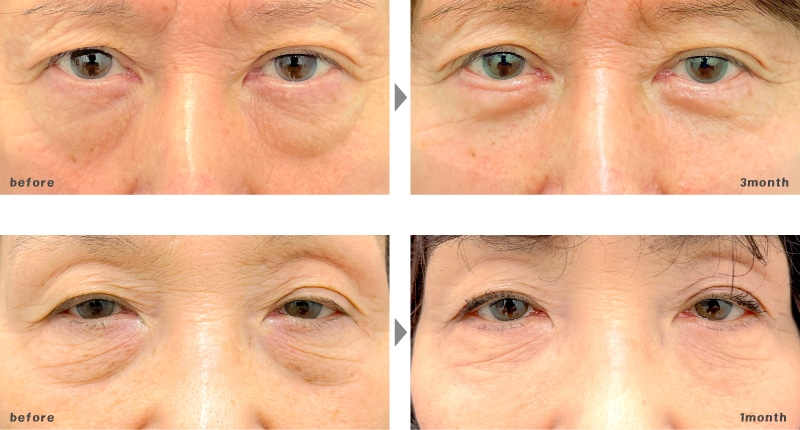 60代 | 切開ハムラ