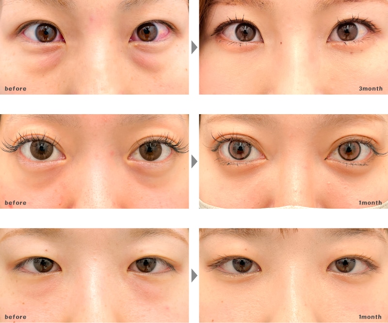 20代 | 目の下の切らないたるみ取り