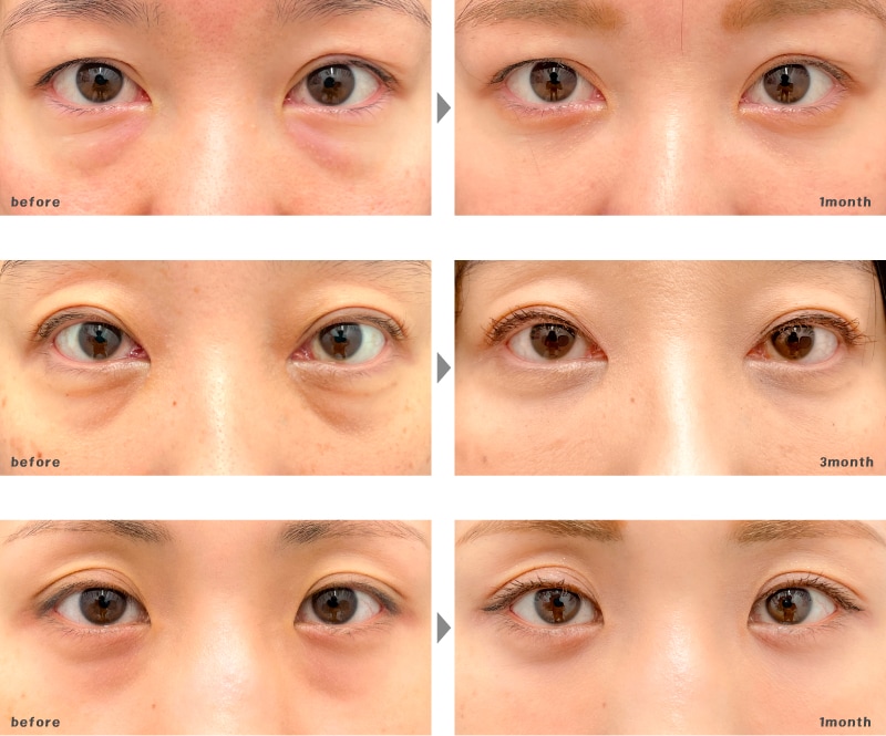 30代 | 目の下の切らないたるみ取り