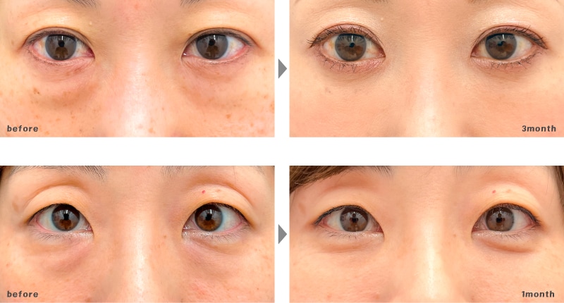 40代 | 目の下の切らないたるみ取り