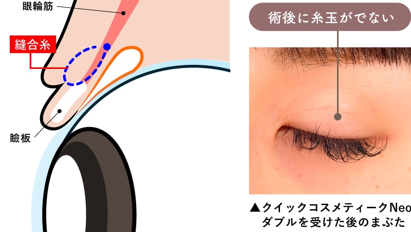 湘南独自の「バレにくい」高品質二重術