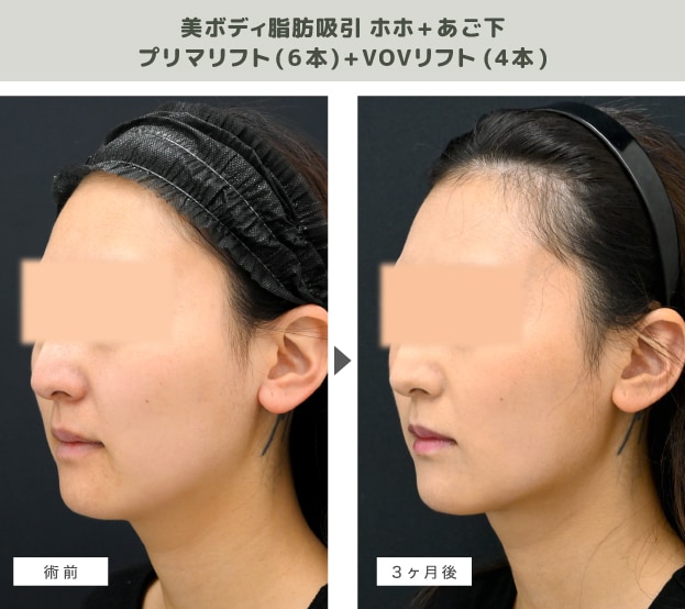 脂肪吸引+糸リフトの症例写真