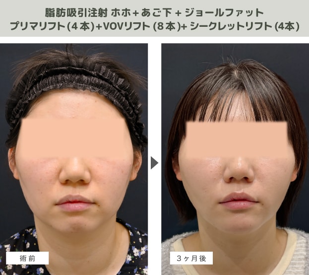 脂肪吸引注射+糸リフトの症例写真