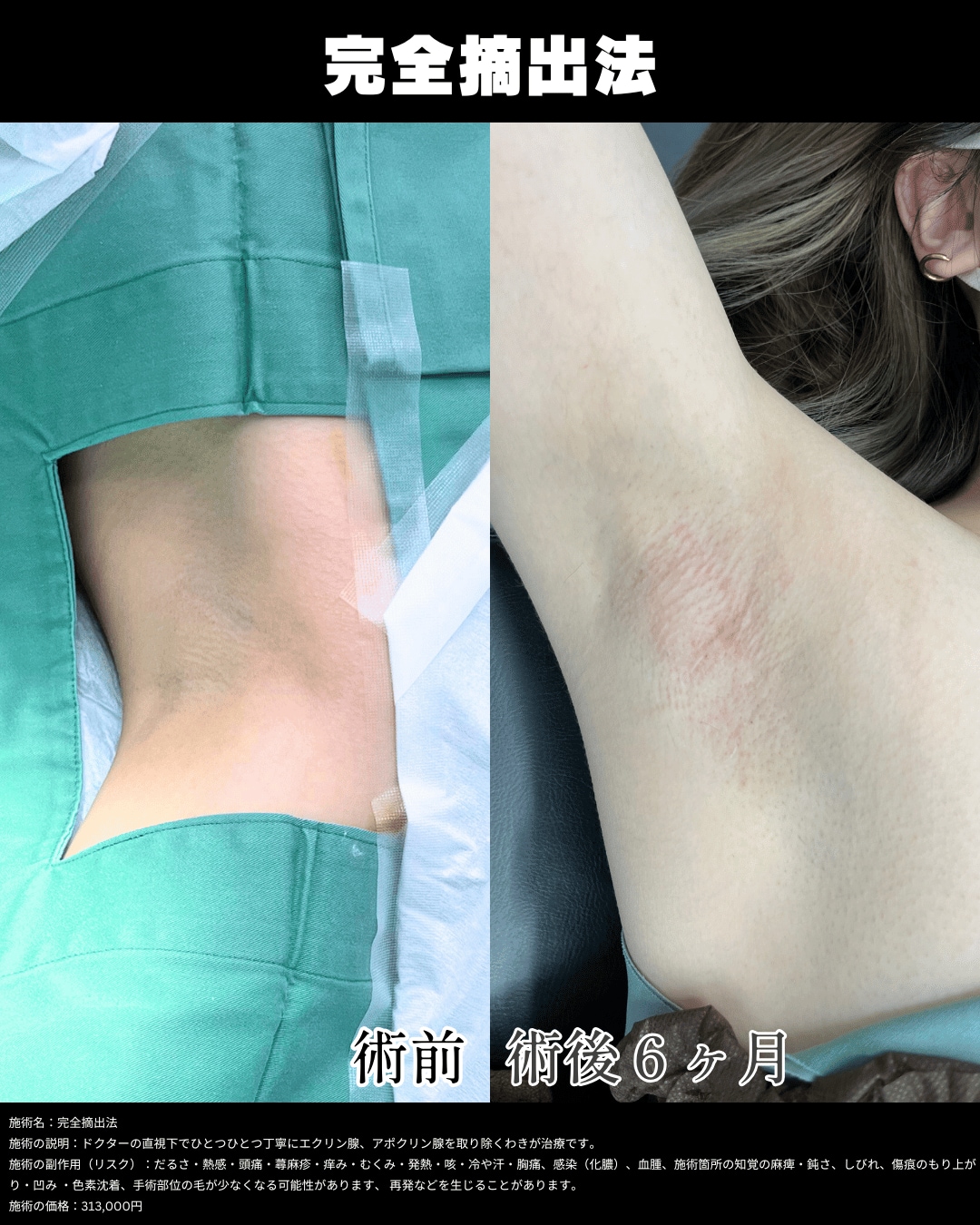 完全摘出法
