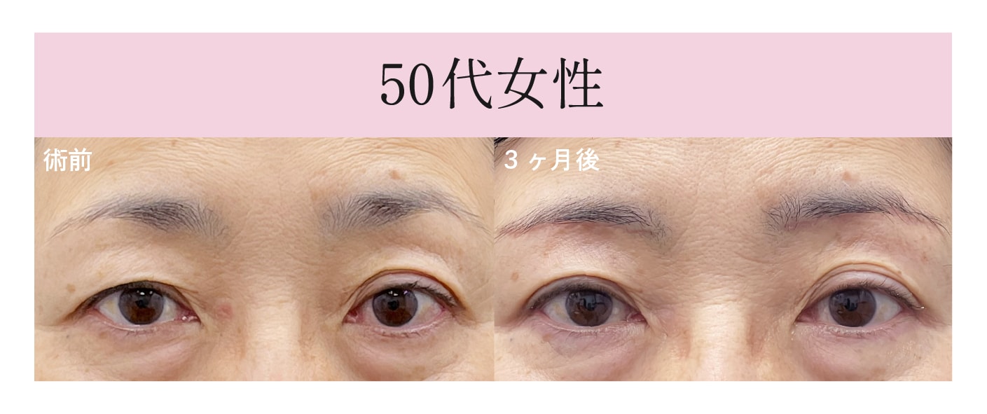 まぶたのたるみを解消したい