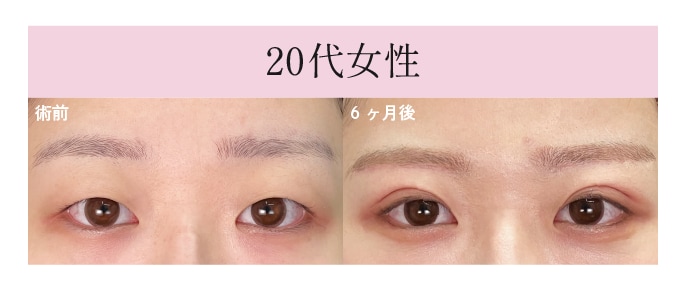 眉下リフト+線留めクロス二重術+デカ目術（切らない眼瞼下垂）