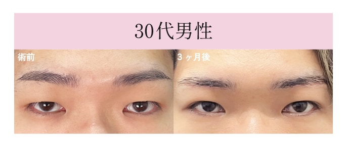 眉下リフト+線留めクロス二重術